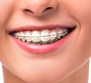 Brackets Keramik