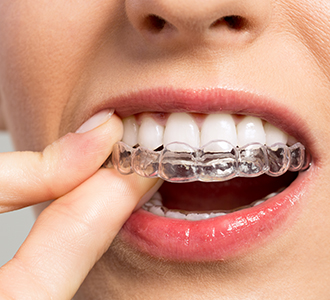 Aligner mundhygiene